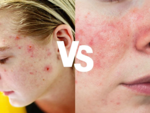 acne on face