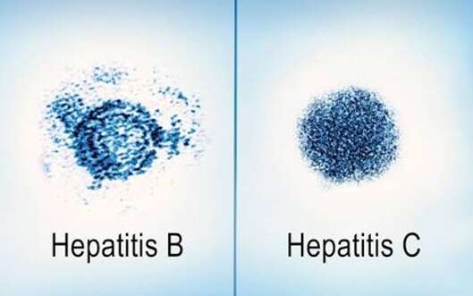 Chronic Hepatitis B Treatment