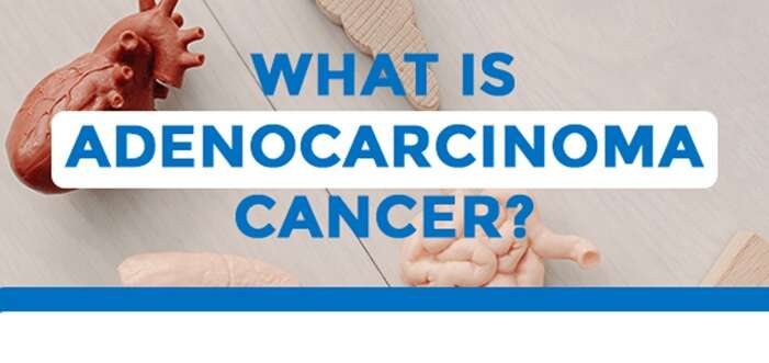 What Is Adenocarcinoma cancer