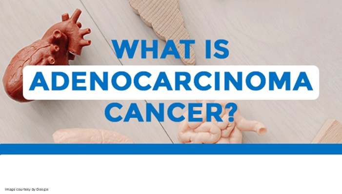 What Is Adenocarcinoma cancer